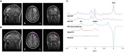 Modulation of Dorsolateral Prefrontal Cortex Glutamate/Glutamine Levels Following Repetitive Transcranial Magnetic Stimulation in Young Adults With Autism